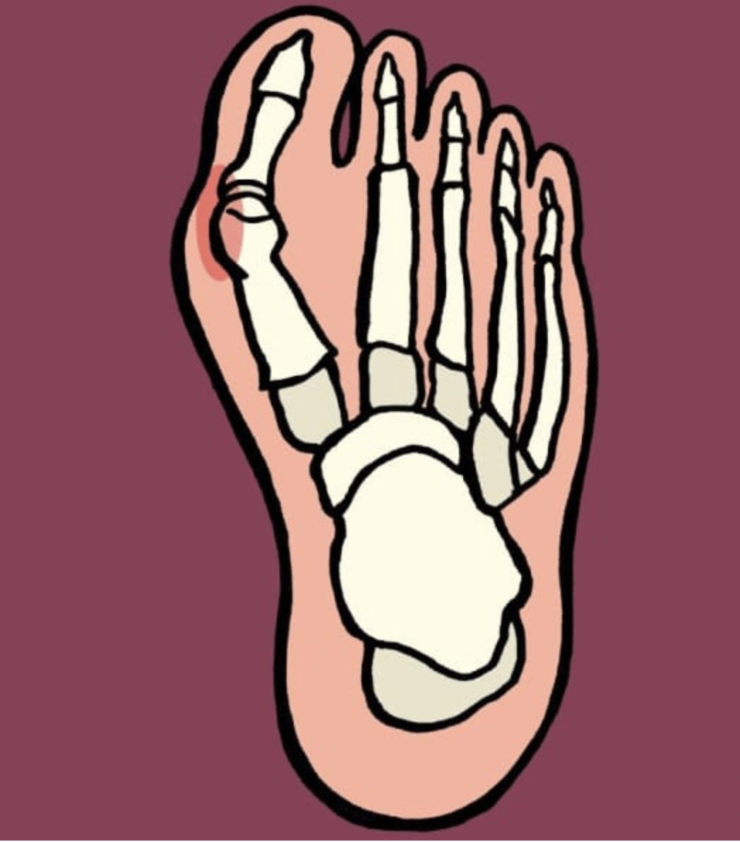 symptoms and signs of a bunion