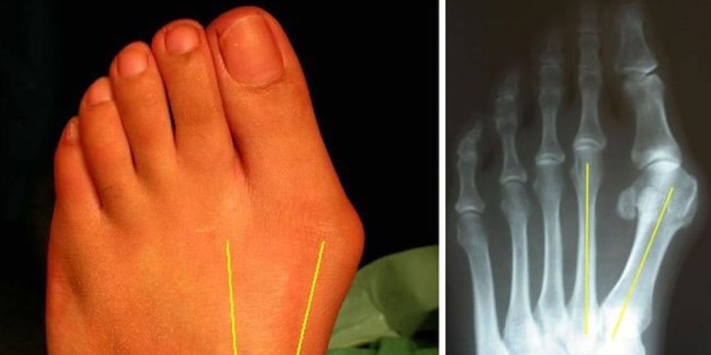 what you need to know about bunions causes and symptoms treatment