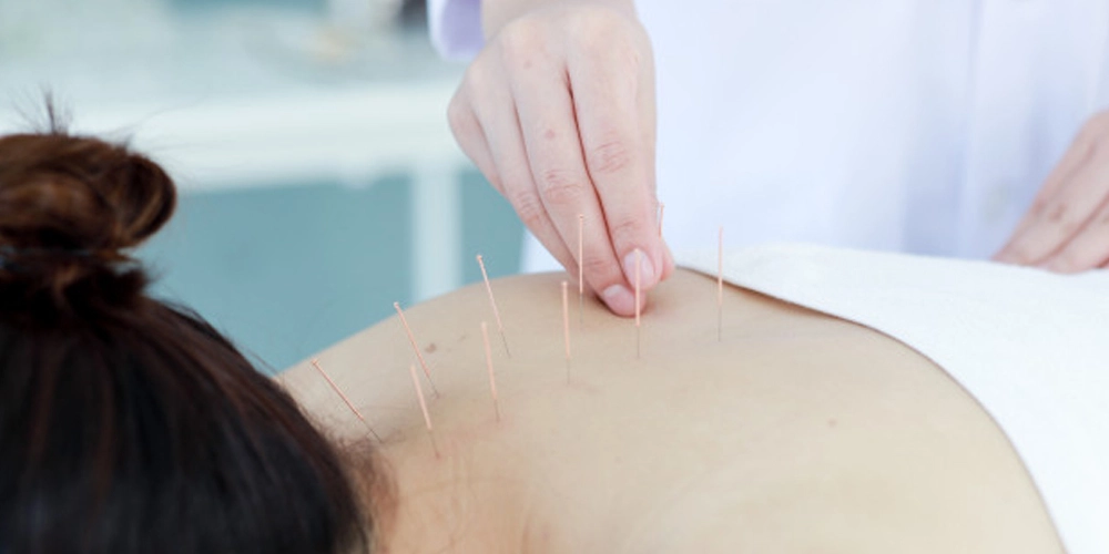 acupuncture what is it and how can you benefit