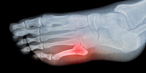 broken toe x-ray image foot pain article series