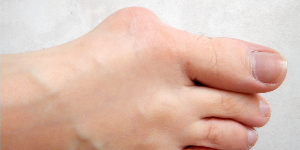 bunions causes and natural treatments article