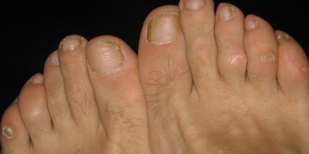 corns and calluses symptoms treatment and frequently asked questions
