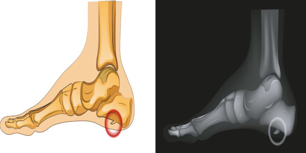 bone spurs heel spurs X-ray image