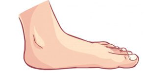flat feet symptoms causes and treatment article