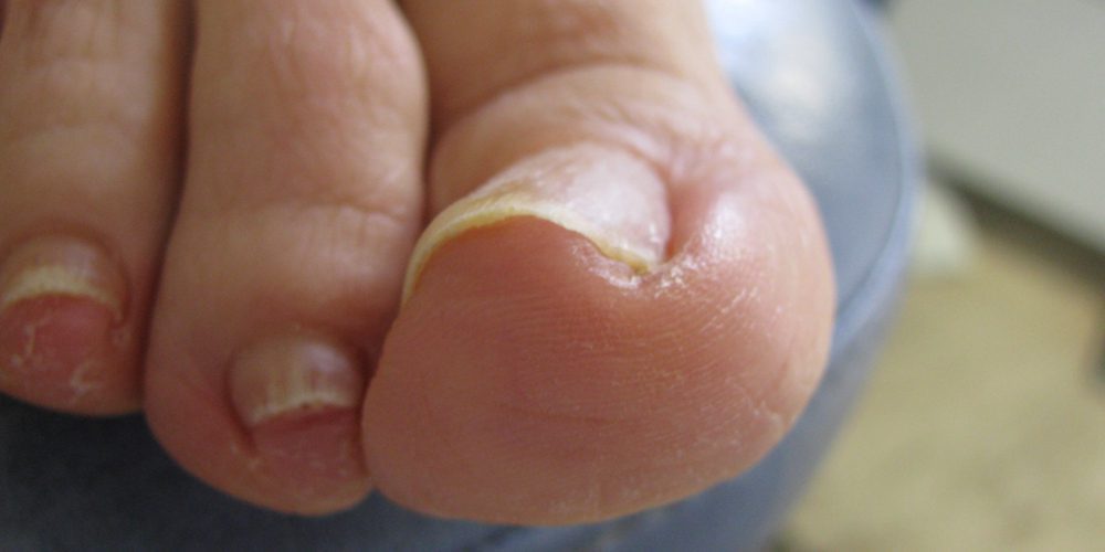ingrown toenails prevention and home remedies