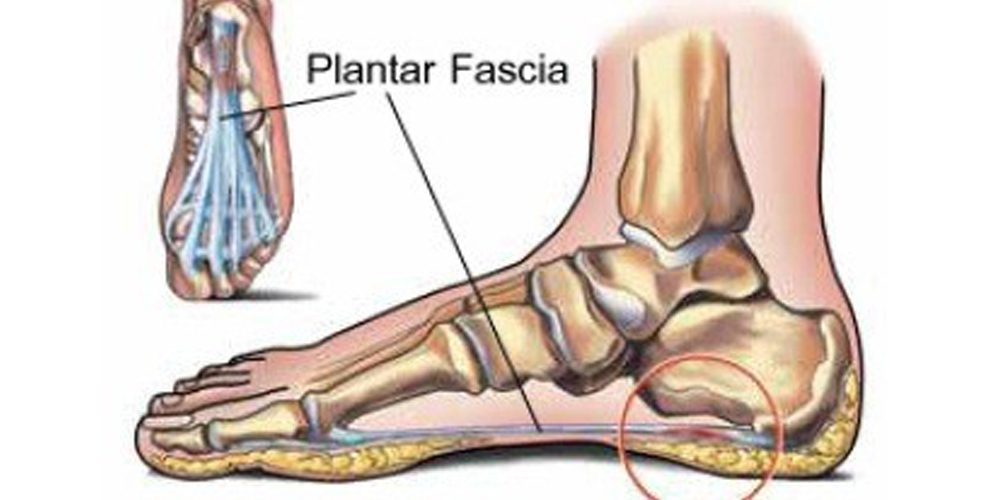plantar fascia tear plantar fascial rupture symptoms diagnosis and treatment