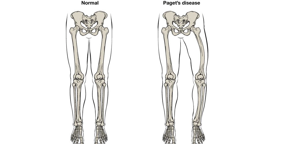 Magnets disease of bone symptoms causes treatment and diagnosis