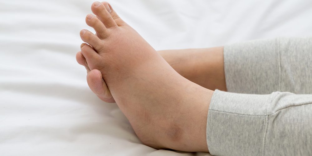 top of foot swollen causes treatment diagnosis and prevention