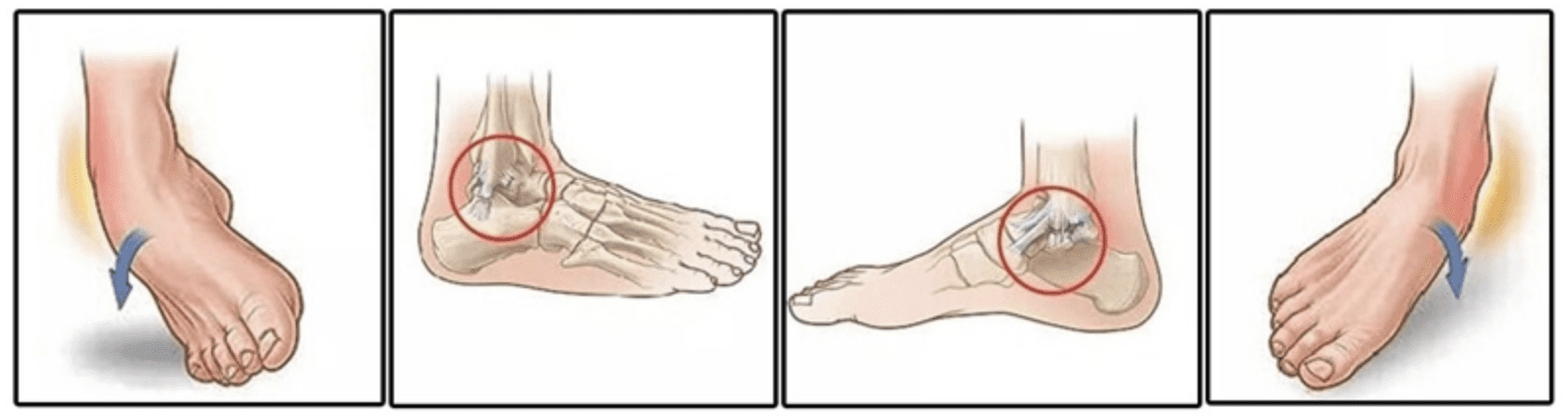 ankle sprain schematic graph illustration