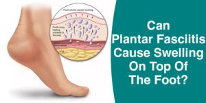 does plantar fasciitis cause swelling on top of foot?