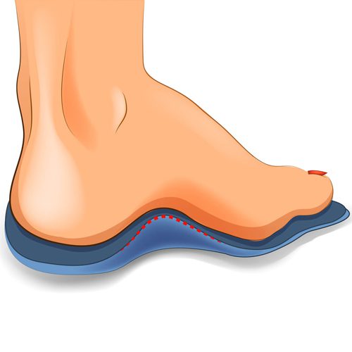 plantar fasciitis how to wear insoles